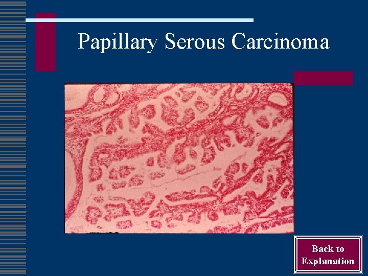 Papillary Serous Carcinoma Back to Explanation 