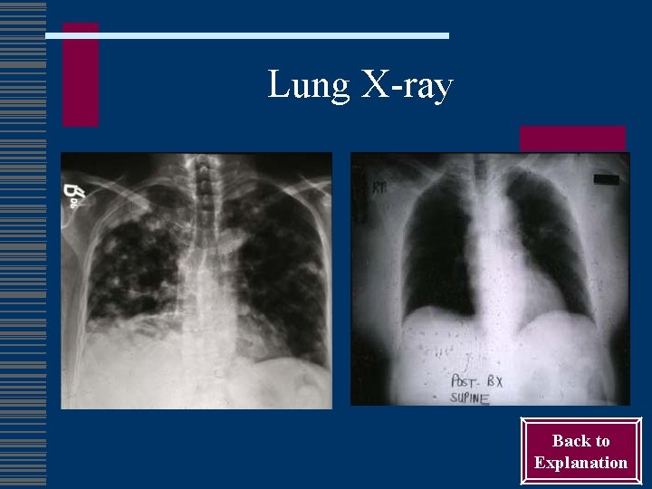 Lung X-ray Back to Explanation 