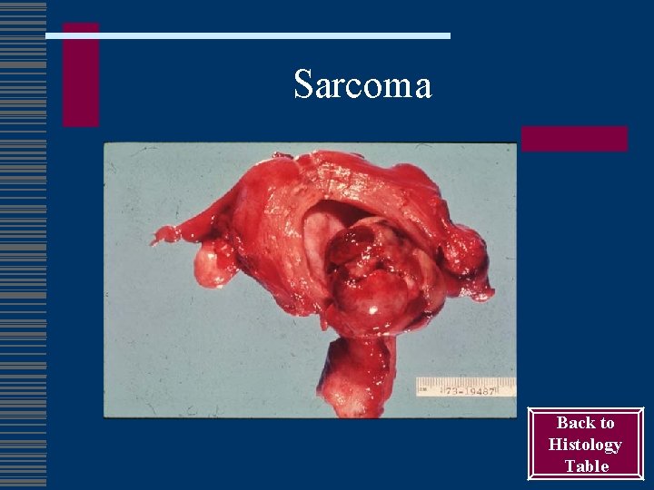 Sarcoma Back to Histology Table 