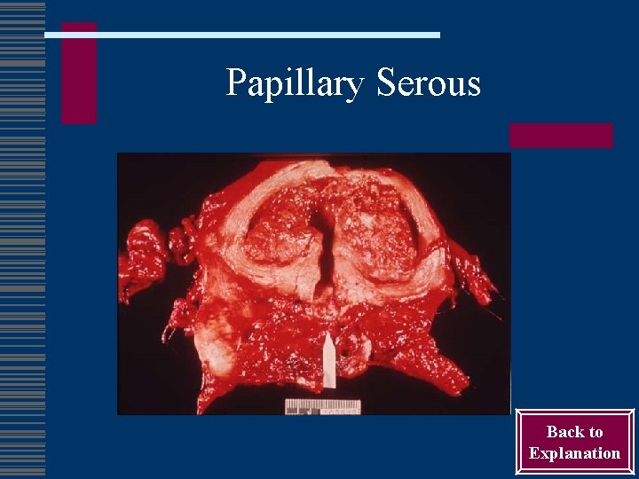 Papillary Serous Back to Explanation 