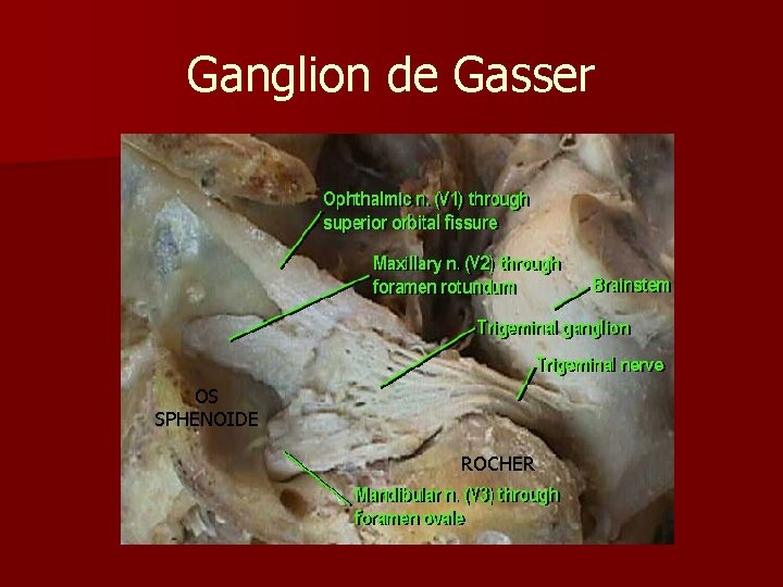 Ganglion de Gasser OS SPHENOIDE ROCHER 