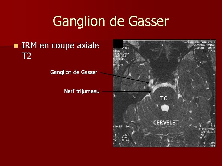 Ganglion de Gasser n IRM en coupe axiale T 2 Ganglion de Gasser Nerf