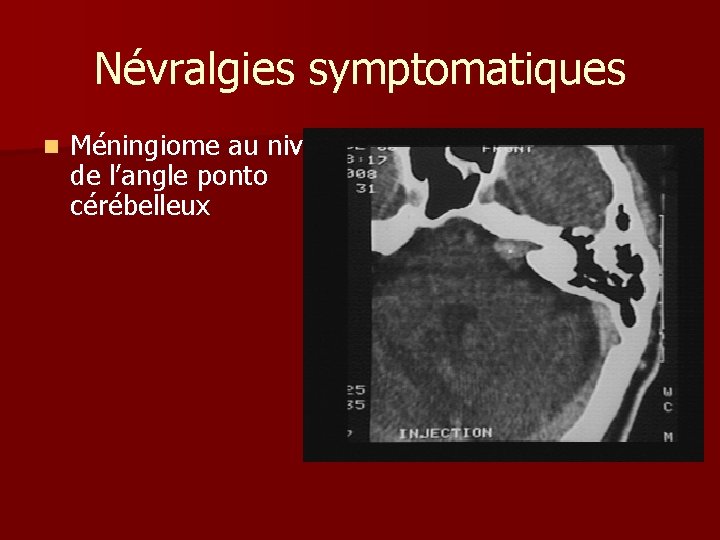 Névralgies symptomatiques n Méningiome au niveau de l’angle ponto cérébelleux 