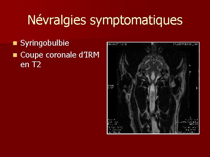 Névralgies symptomatiques Syringobulbie n Coupe coronale d’IRM en T 2 n 