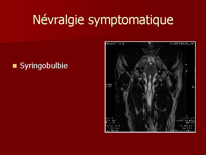 Névralgie symptomatique n Syringobulbie 