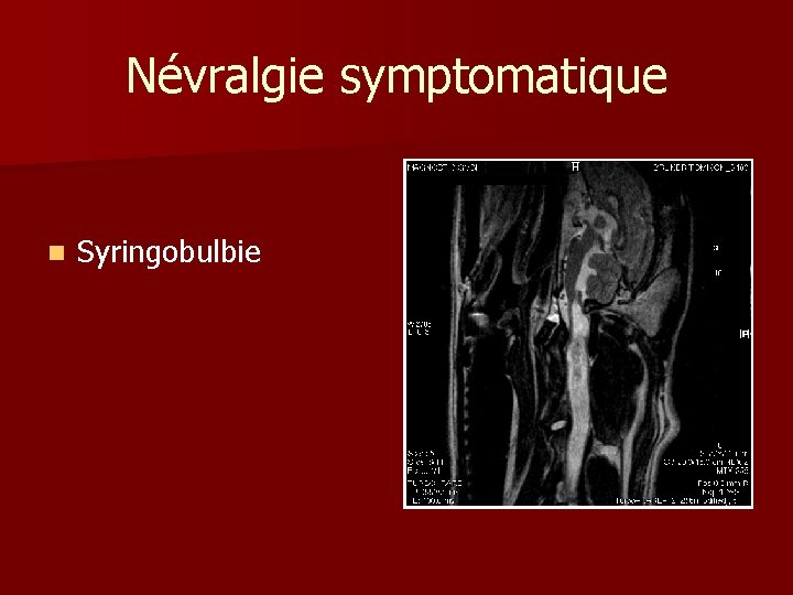 Névralgie symptomatique n Syringobulbie 