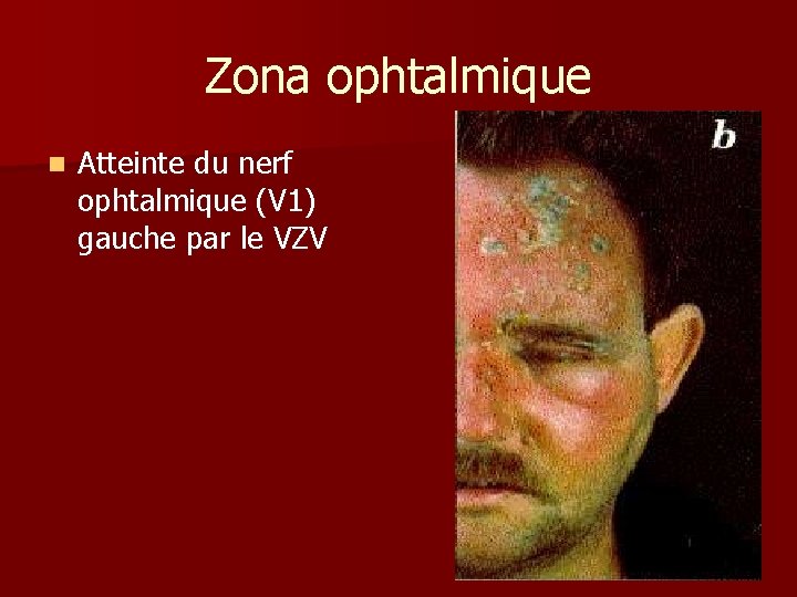 Zona ophtalmique n Atteinte du nerf ophtalmique (V 1) gauche par le VZV 