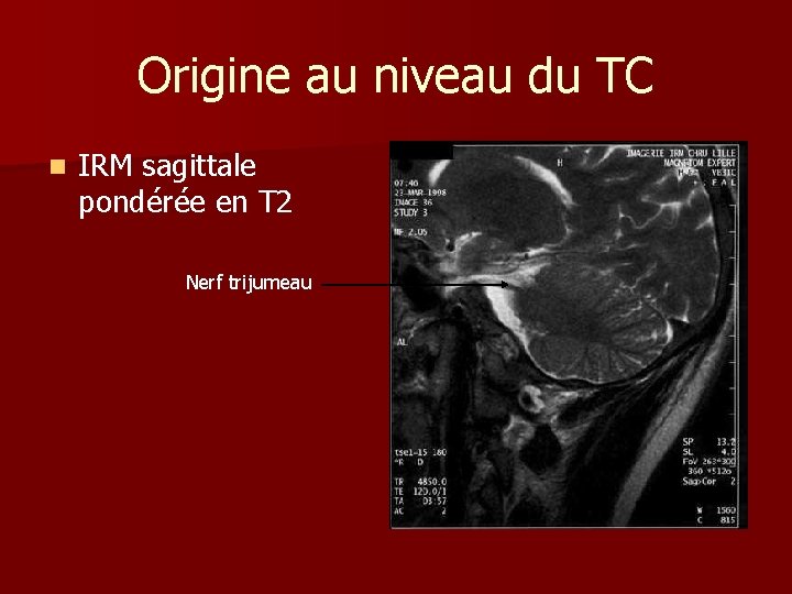 Origine au niveau du TC n IRM sagittale pondérée en T 2 Nerf trijumeau