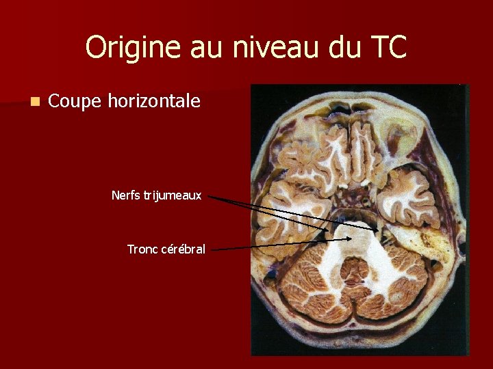 Origine au niveau du TC n Coupe horizontale Nerfs trijumeaux Tronc cérébral 