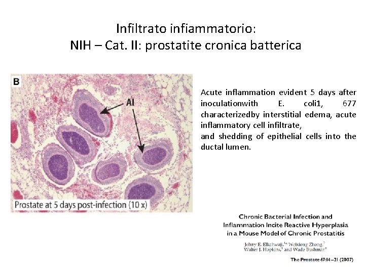 Infiltrato infiammatorio: NIH – Cat. II: prostatite cronica batterica Acute inflammation evident 5 days