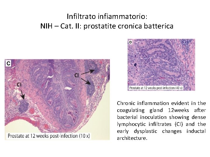 Infiltrato infiammatorio: NIH – Cat. II: prostatite cronica batterica Chronic inflammation evident in the
