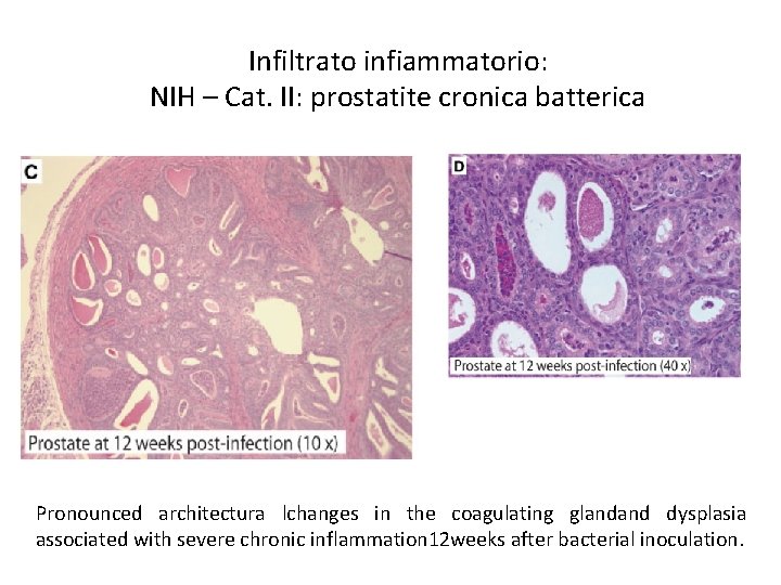 Infiltrato infiammatorio: NIH – Cat. II: prostatite cronica batterica Pronounced architectura lchanges in the