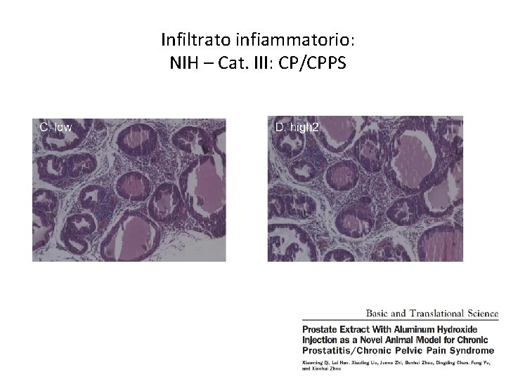 Infiltrato infiammatorio: NIH – Cat. III: CP/CPPS 