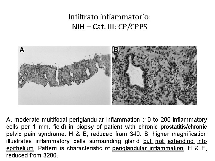 Infiltrato infiammatorio: NIH – Cat. III: CP/CPPS A, moderate multifocal periglandular inflammation (10 to