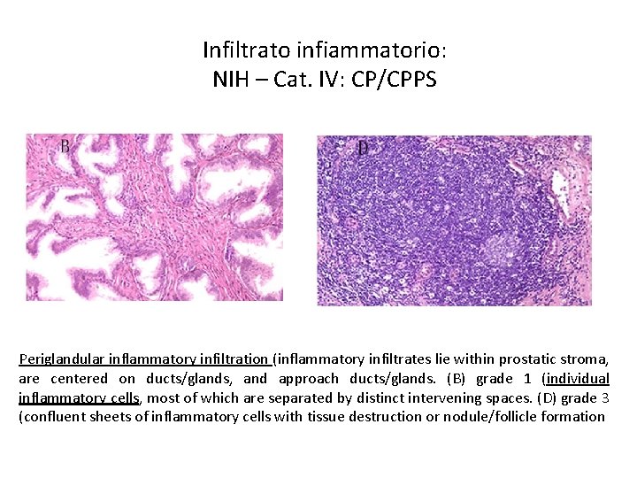 Infiltrato infiammatorio: NIH – Cat. IV: CP/CPPS Periglandular inflammatory infiltration (inflammatory infiltrates lie within