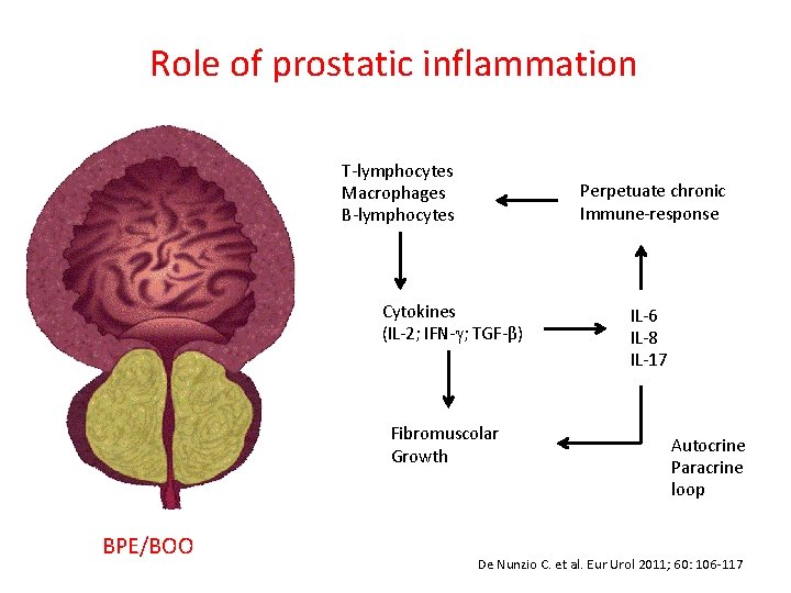 Role of prostatic inflammation T-lymphocytes Macrophages B-lymphocytes Perpetuate chronic Immune-response Cytokines (IL-2; IFN- ; Role of prostatic inflammation T-lymphocytes Macrophages B-lymphocytes Perpetuate chronic Immune-response Cytokines (IL-2; IFN- ;