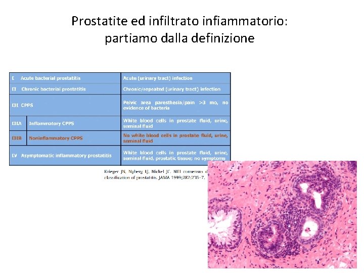 Prostatite ed infiltrato infiammatorio: partiamo dalla definizione 