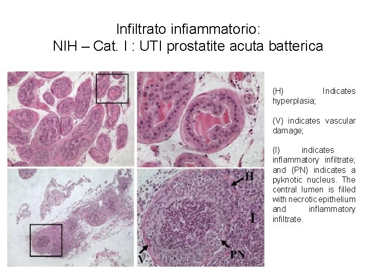 Infiltrato infiammatorio: NIH – Cat. I : UTI prostatite acuta batterica (H) Indicates hyperplasia;