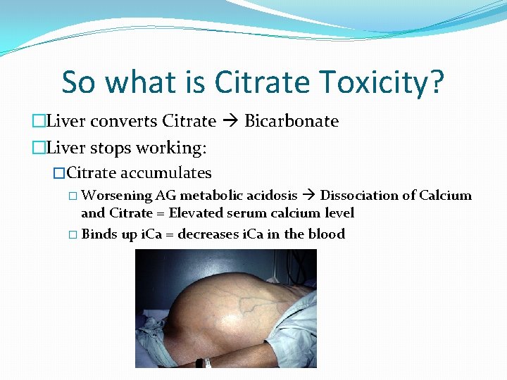 So what is Citrate Toxicity? �Liver converts Citrate Bicarbonate �Liver stops working: �Citrate accumulates So what is Citrate Toxicity? �Liver converts Citrate Bicarbonate �Liver stops working: �Citrate accumulates
