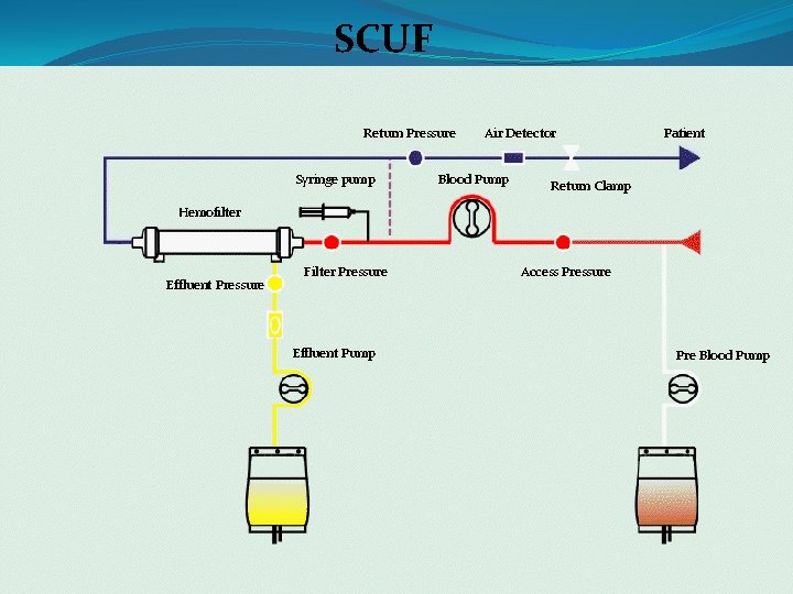 SCUF Return Pressure Syringe pump Air Detector Blood Pump Patient Return Clamp Hemofilter Effluent SCUF Return Pressure Syringe pump Air Detector Blood Pump Patient Return Clamp Hemofilter Effluent