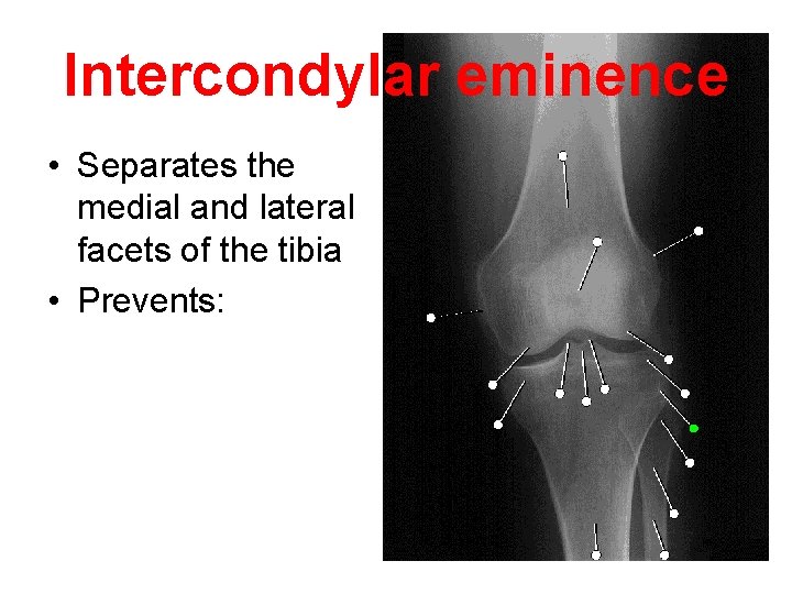 Intercondylar eminence • Separates the medial and lateral facets of the tibia • Prevents: