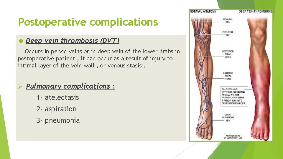 Postoperative complications Deep vein thrombosis (DVT) Occurs in pelvic veins or in deep vein