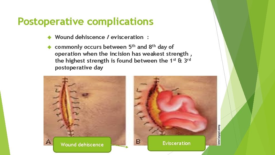 Postoperative complications Wound dehiscence / evisceration : commonly occurs between 5 th and 8