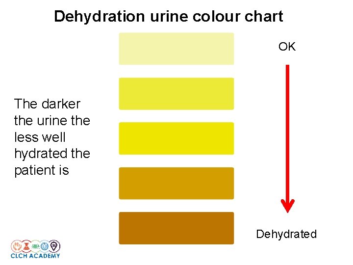 Dehydration urine colour chart OK The darker the urine the less well hydrated the