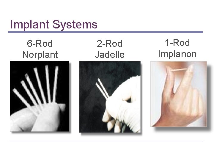 Implant Systems 6 -Rod Norplant 2 -Rod Jadelle 1 -Rod Implanon 