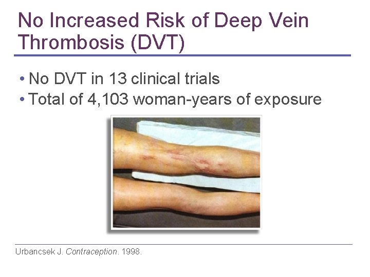 No Increased Risk of Deep Vein Thrombosis (DVT) • No DVT in 13 clinical