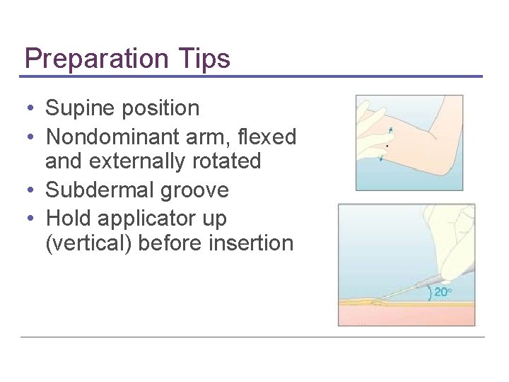 Preparation Tips • Supine position • Nondominant arm, flexed and externally rotated • Subdermal