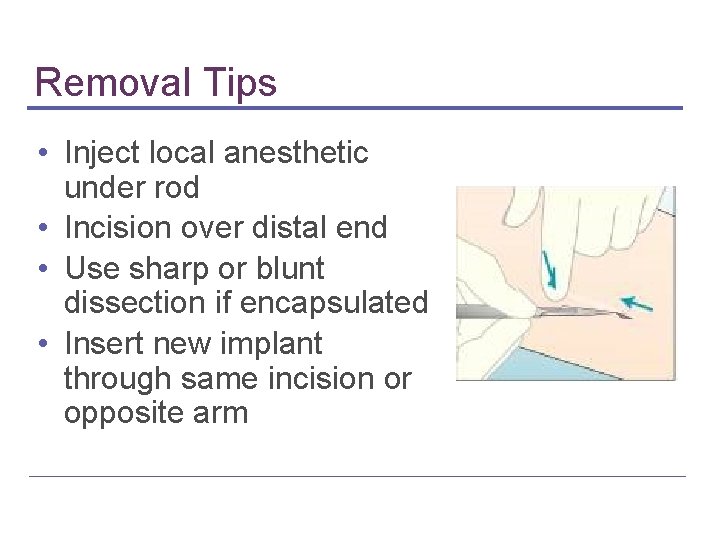 Removal Tips • Inject local anesthetic under rod • Incision over distal end •