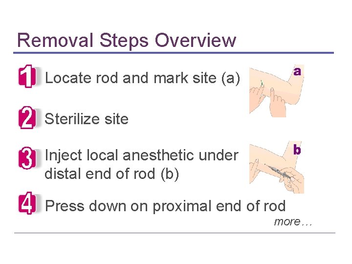 Removal Steps Overview Locate rod and mark site (a) Sterilize site Inject local anesthetic