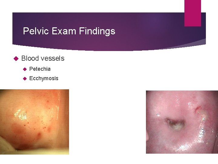 Pelvic Exam Findings Blood vessels Petechia Ecchymosis 