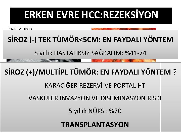 ERKEN EVRE HCC: REZEKSİYON Child A, PST 0, SİROZ (-) TEK TÜMÖR<5 CM: EN