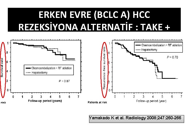 ERKEN EVRE (BCLC A) HCC REZEKSİYONA ALTERNATİF : TAKE + RFA Yamakado K et