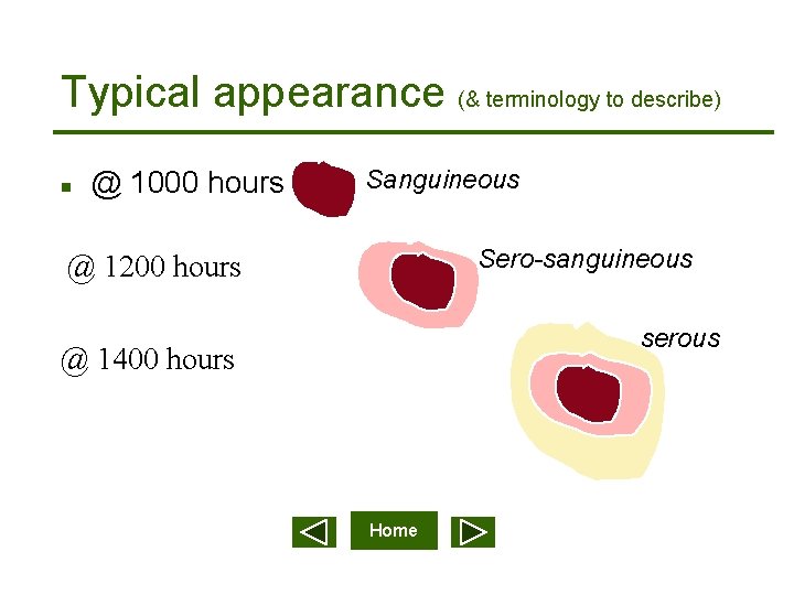 Typical appearance (& terminology to describe) n @ 1000 hours Sanguineous Sero-sanguineous @ 1200