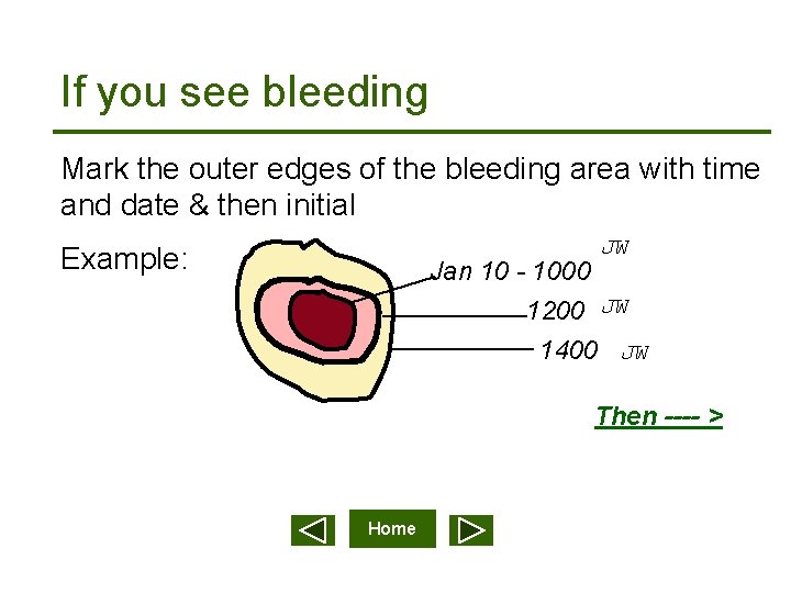 If you see bleeding Mark the outer edges of the bleeding area with time