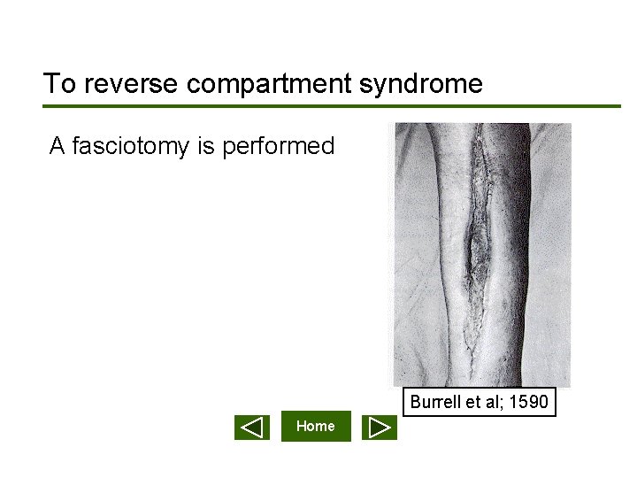 To reverse compartment syndrome A fasciotomy is performed Burrell et al; 1590 Home 