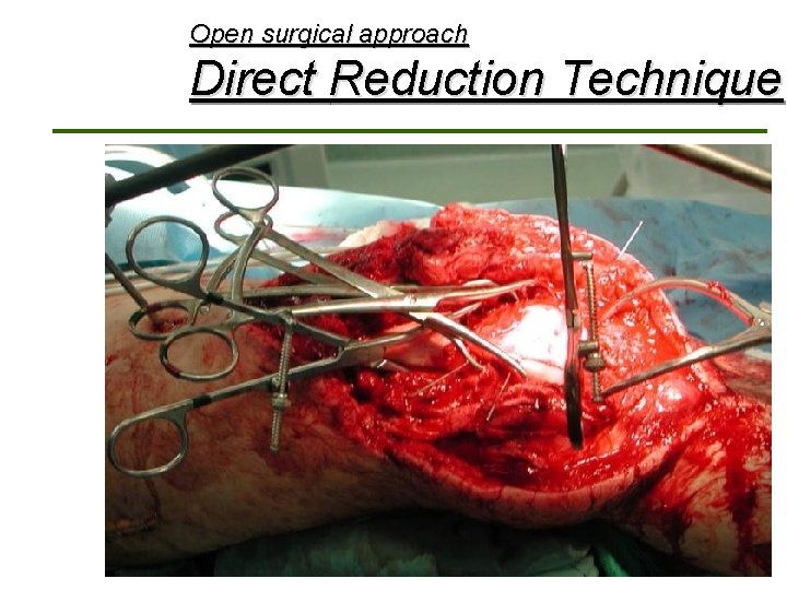 Open surgical approach Direct Reduction Technique Home 