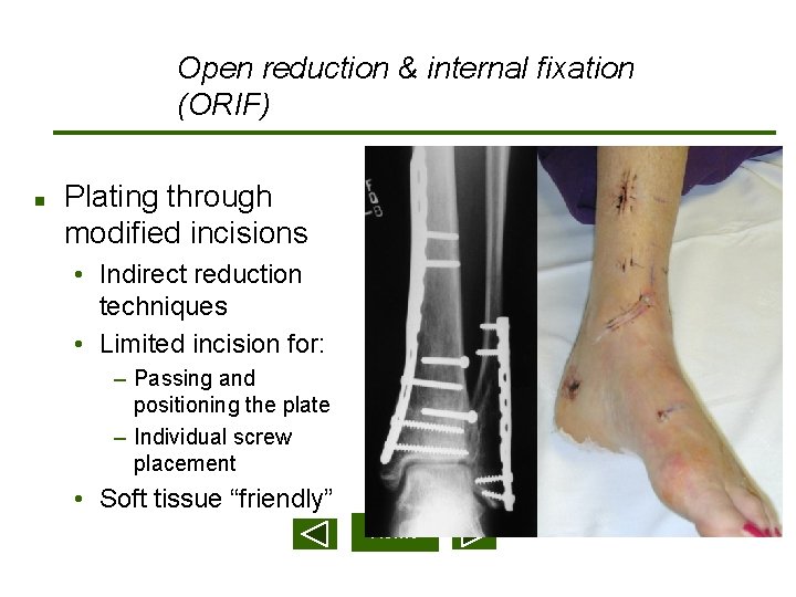 Open reduction & internal fixation (ORIF) n Plating through modified incisions • Indirect reduction