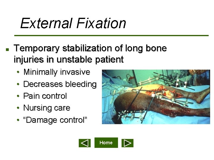 External Fixation n Temporary stabilization of long bone injuries in unstable patient • •