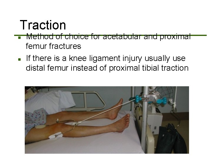 Traction n n Method of choice for acetabular and proximal femur fractures If there
