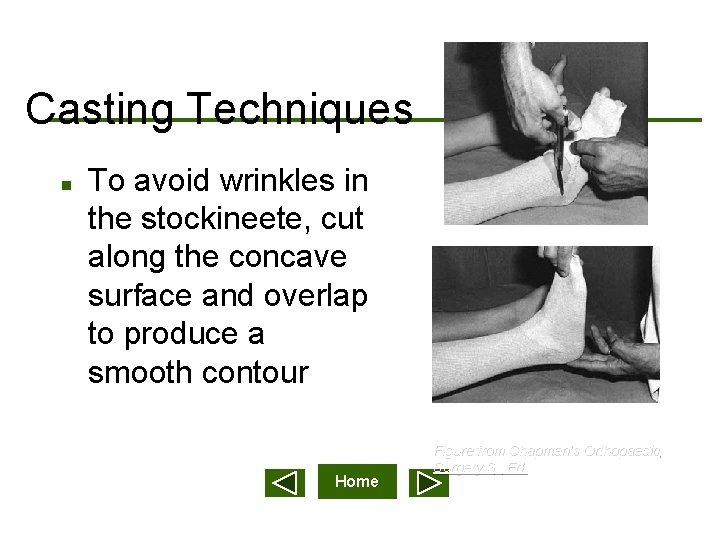 Casting Techniques n To avoid wrinkles in the stockineete, cut along the concave surface