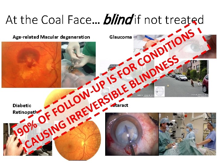 At the Coal Face… blind if not treated S N O I T I