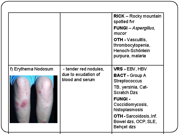 RICK – Rocky mountain spotted fvr FUNGI – Aspergillus, mucor OTH - Vasculitis, thrombocytopenia,