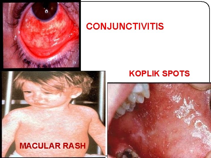 CONJUNCTIVITIS KOPLIK SPOTS MACULAR RASH 