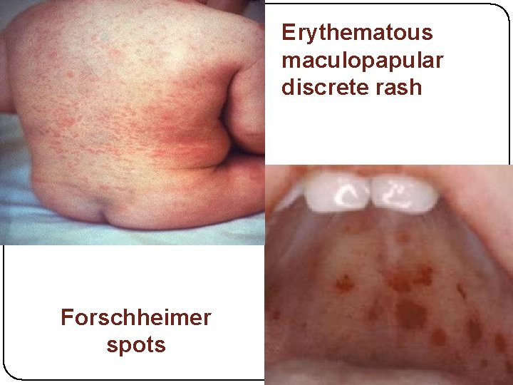 Erythematous maculopapular discrete rash Forschheimer spots 