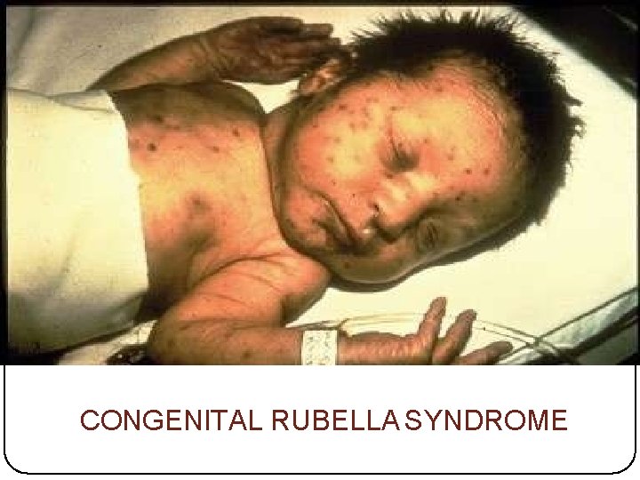 CONGENITAL RUBELLA SYNDROME 