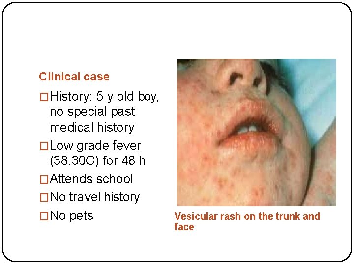 Clinical case �History: 5 y old boy, no special past medical history �Low grade